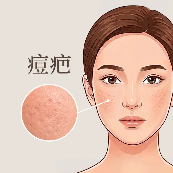 痘疤