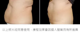 減脂三重奏瘦小腹效果