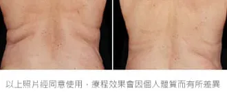 減脂三重奏瘦後腰