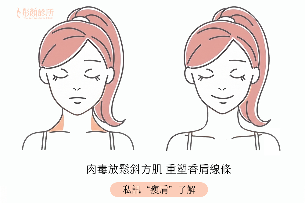 肉毒瘦肩改善斜方肌效果