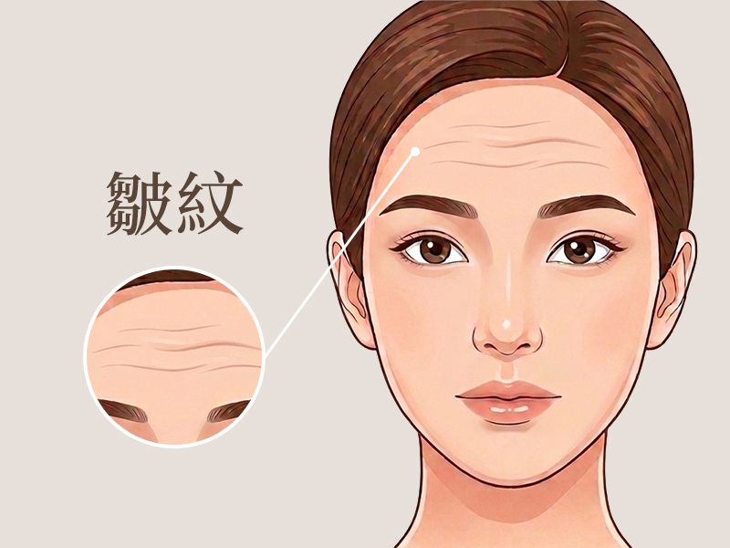 皺紋-除皺-消除皺紋-醫美除皺-皺紋治療-動態紋-靜態-紋