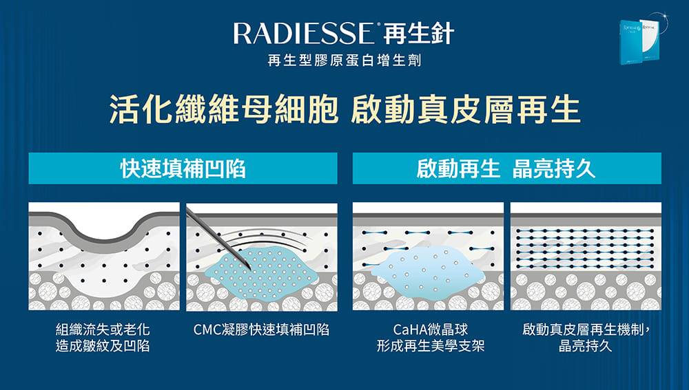 再生針-膠原蛋白增生劑-Radiesse-晶亮瓷-山根-法令紋-淚溝填補-隆鼻-墊下巴-蘋果肌-藝術面雕